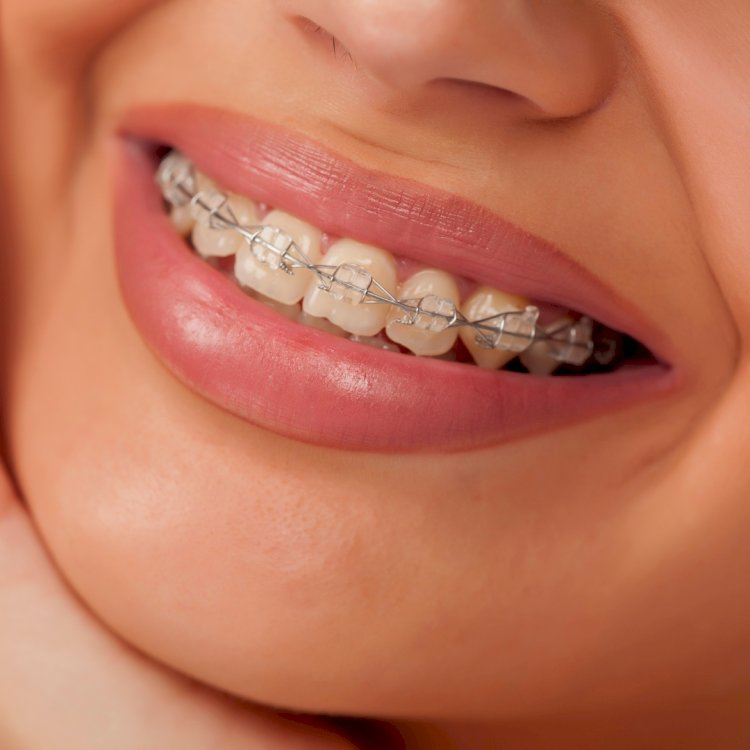 6 Common Braces Problems and How to Fix Them