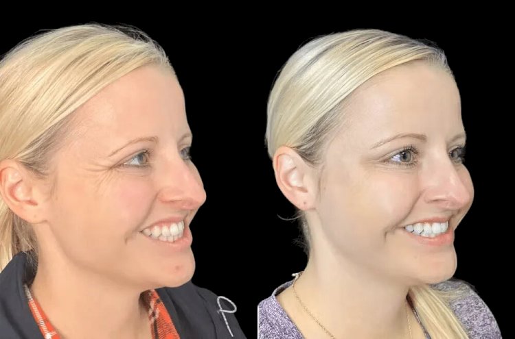 Why the Best Aesthetic Clinics in dubai Are Leading the Botox Industry