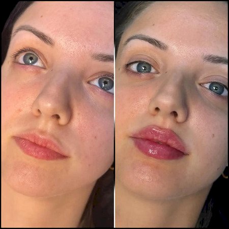 Best Plastic Surgeons in dubai for Non-Surgical Neck and Chin Fillers