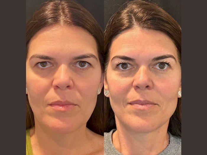 Recovery Tips After a Thread Lift from the Best Plastic Surgeon in Dubai