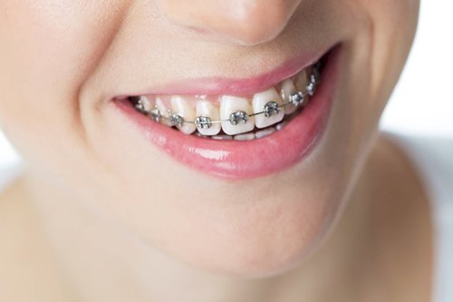 Who Should Avoid Low Teeth Braces Costs in Dubai?