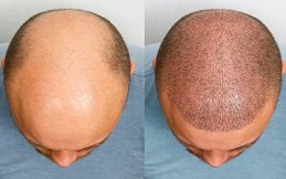 فوائد زراعة الشعر في الرياض مقارنة بالعلاجات الأخرى