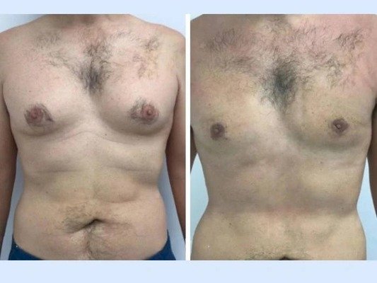 Gynecomastia in Dubai: How to Speed Up Surgical Recovery