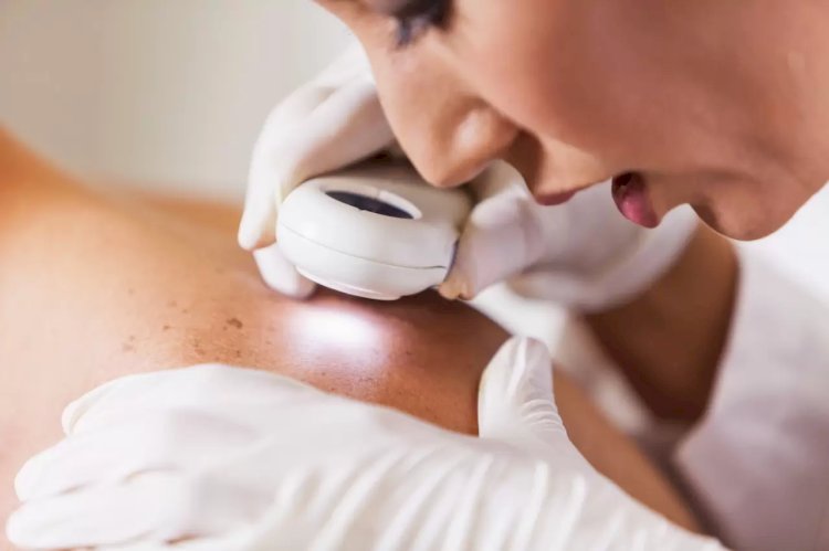 What Aftercare Is Needed for Skin Tag Removal in Dubai?