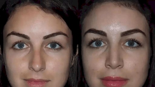 Expert Surgeons for Septoplasty in Dubai