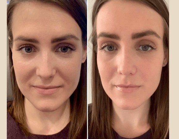 Best Plastic Surgeon in dubai for PRP Treatment for Men and Women