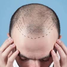 دليلك الشامل حول زراعة الشعر في الرياض: التقنيات، التكلفة، والنتائج المتوقعة